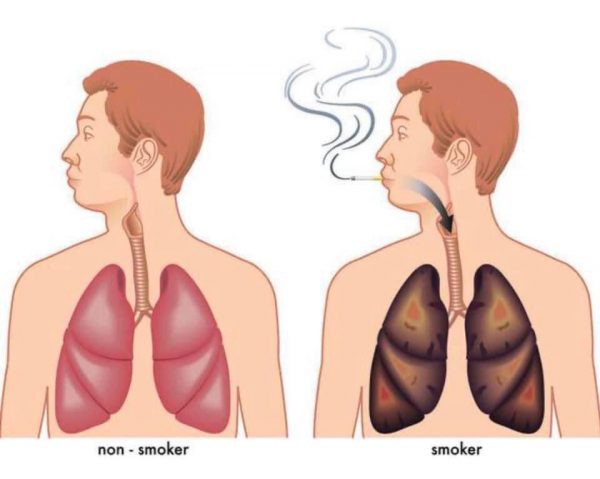健康的肺和吸煙的肺
